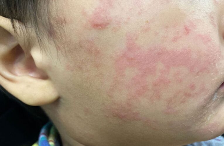 Advierten que plan antivacunas de Florida abre la puerta al sarampión en EE.UU.