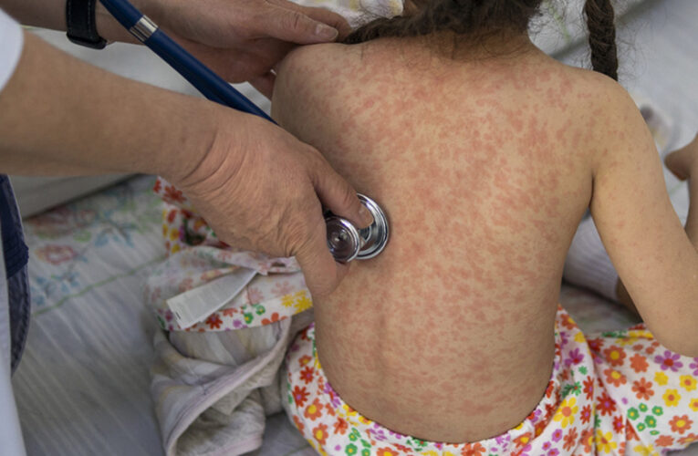 Ante los nuevos brotes de sarampión: ¿solo los niños deben vacunarse?