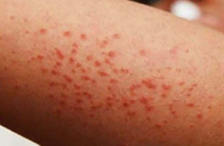 Investigan posible segunda muerte por sarampión en CDMX